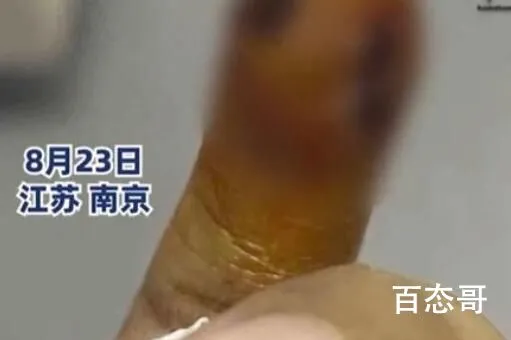 女子拔倒刺致骨髓炎要刮骨手术 背后的真相让人始料未及